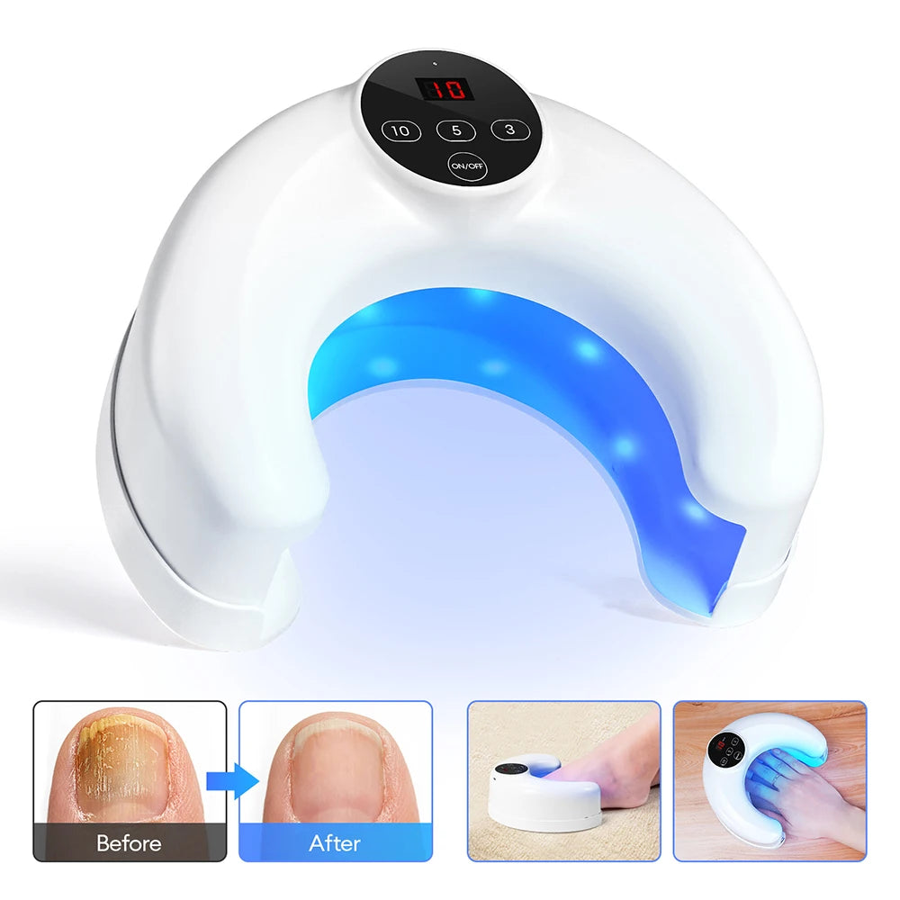 Revolutionary Wireless Toenail Fungus Treatment Lamp - Infrared & Blue Light Laser Device for Effective Nail Health